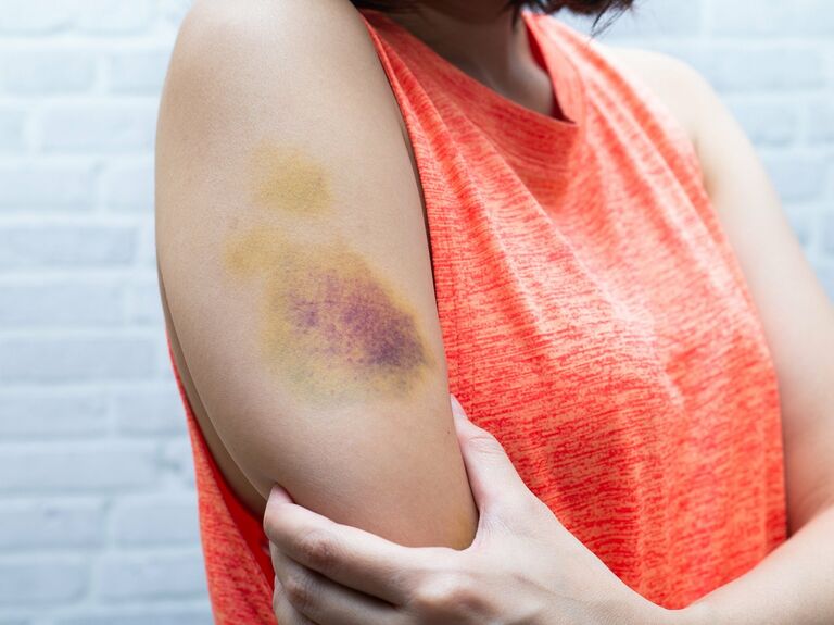 Heal Bruises