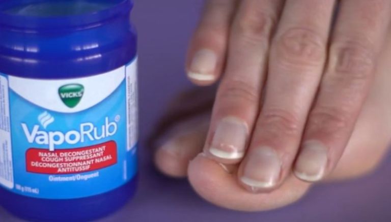 Get Rid of Nail Fungus